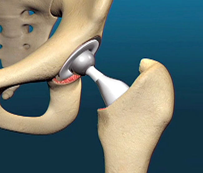 Hip Replacement Surgery