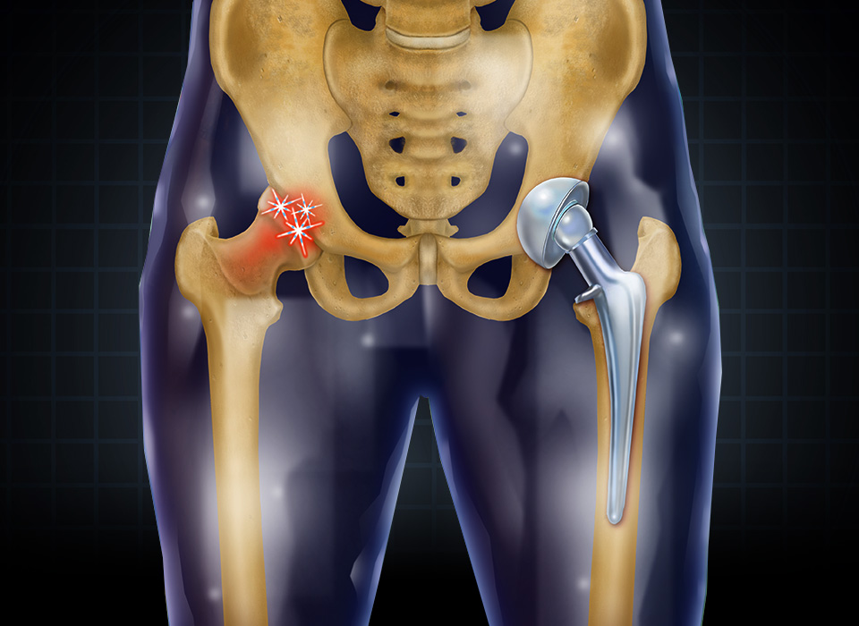 Hip Replacement Surgeon